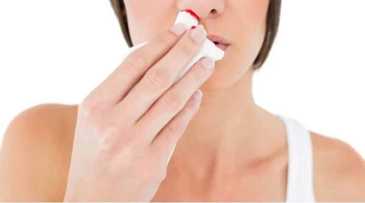 FREQUENT NOSEBLEEDS – WHEN SHOULD YOU SEE A DOCTOR?
