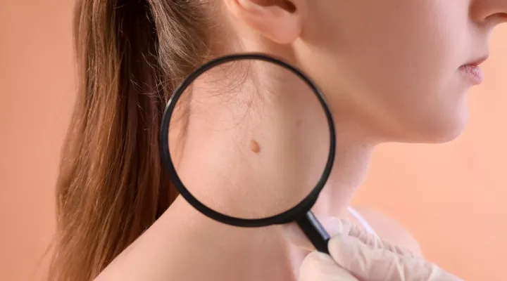 What Has Summer Left Behind on Your Skin? – Moles and Pigmentation After the Summer Months