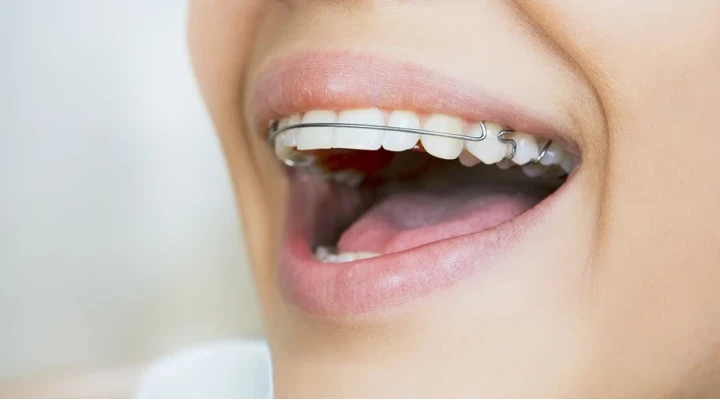 Megfelelő szájápolás a fogszabályozás ideje alatt