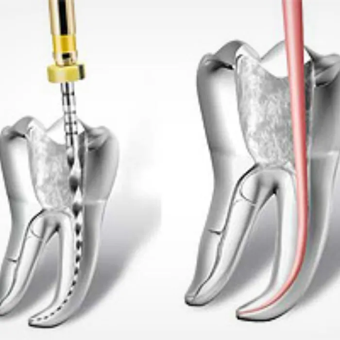 Endodoncia, mikroszkópos gyökérkezelés 