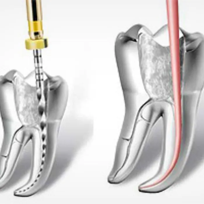 Endodontics, microscopic root canal treatment