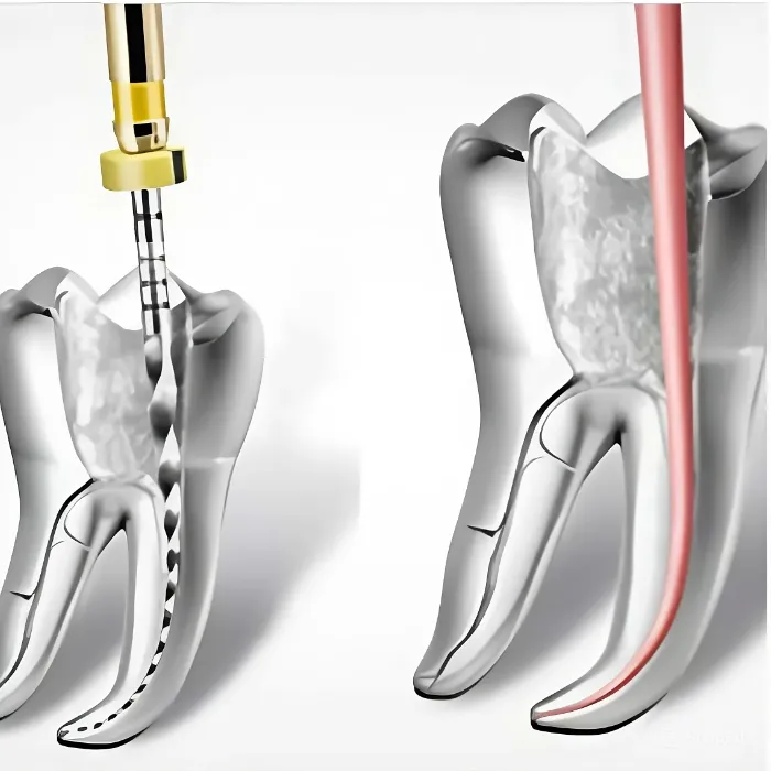 Mikroszkópos gyökérkezelés - endodoncia