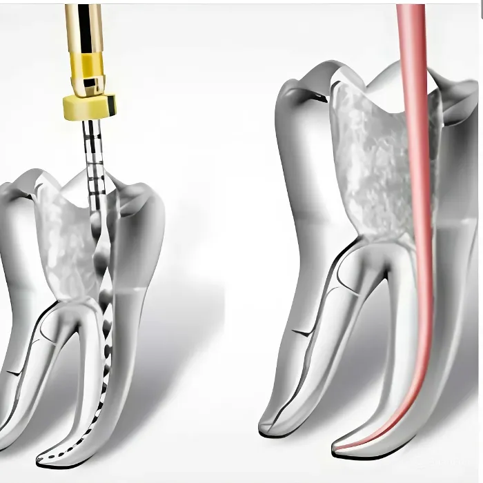 Microscopic Root Canal Treatment - Endodontics