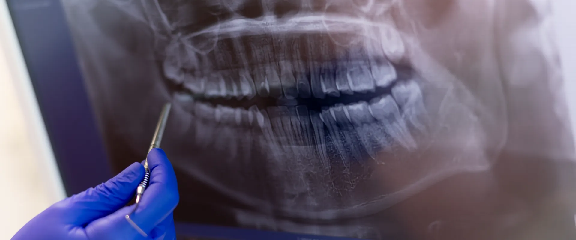 Ingyenes panoráma röntgen vagy 3D CBCT fogászati állapotfelmérés mellé